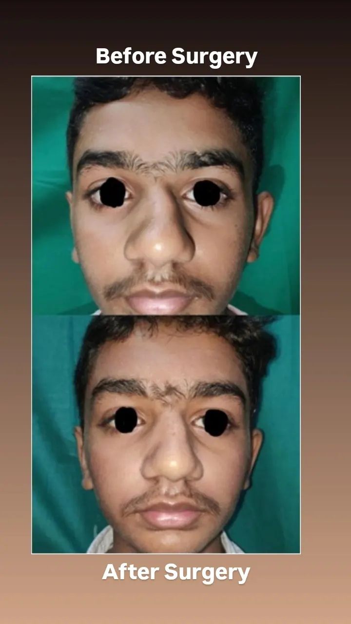 rhinoplasty