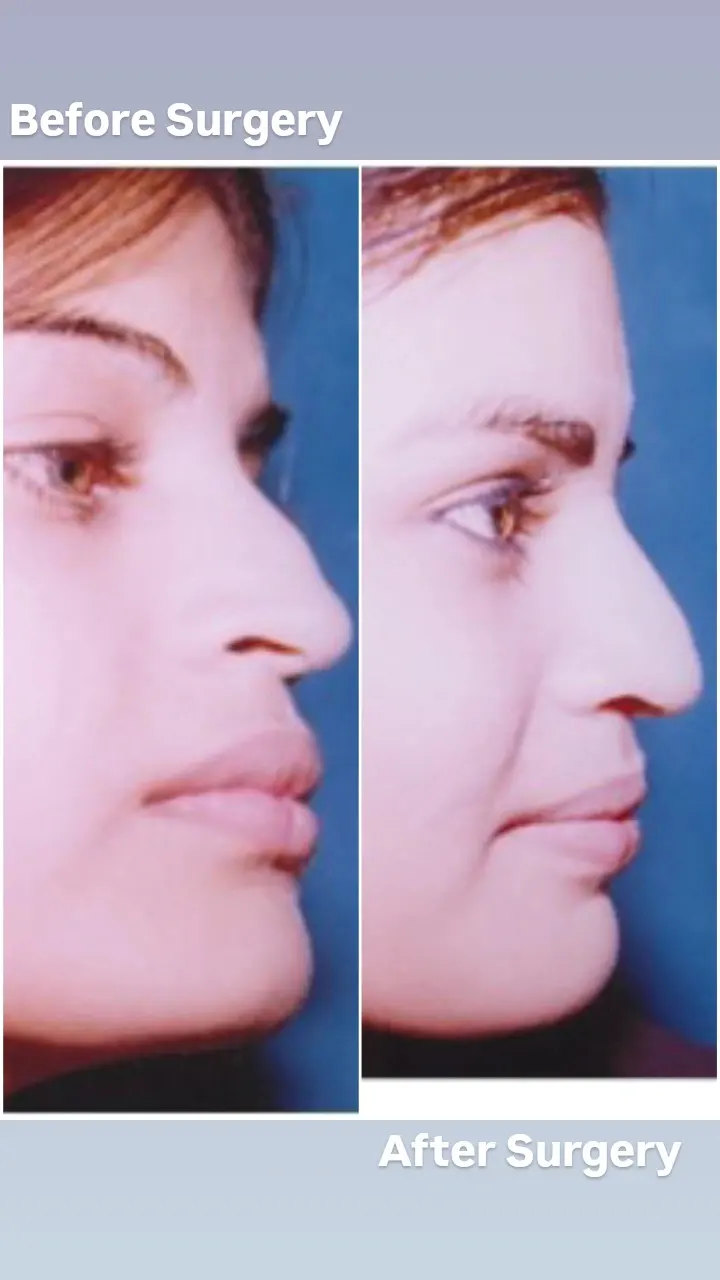 rhinoplasty