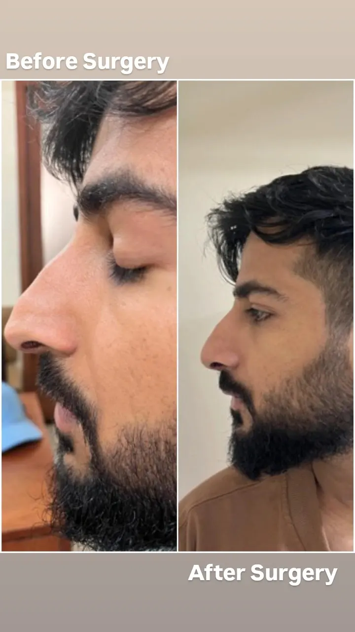 rhinoplasty