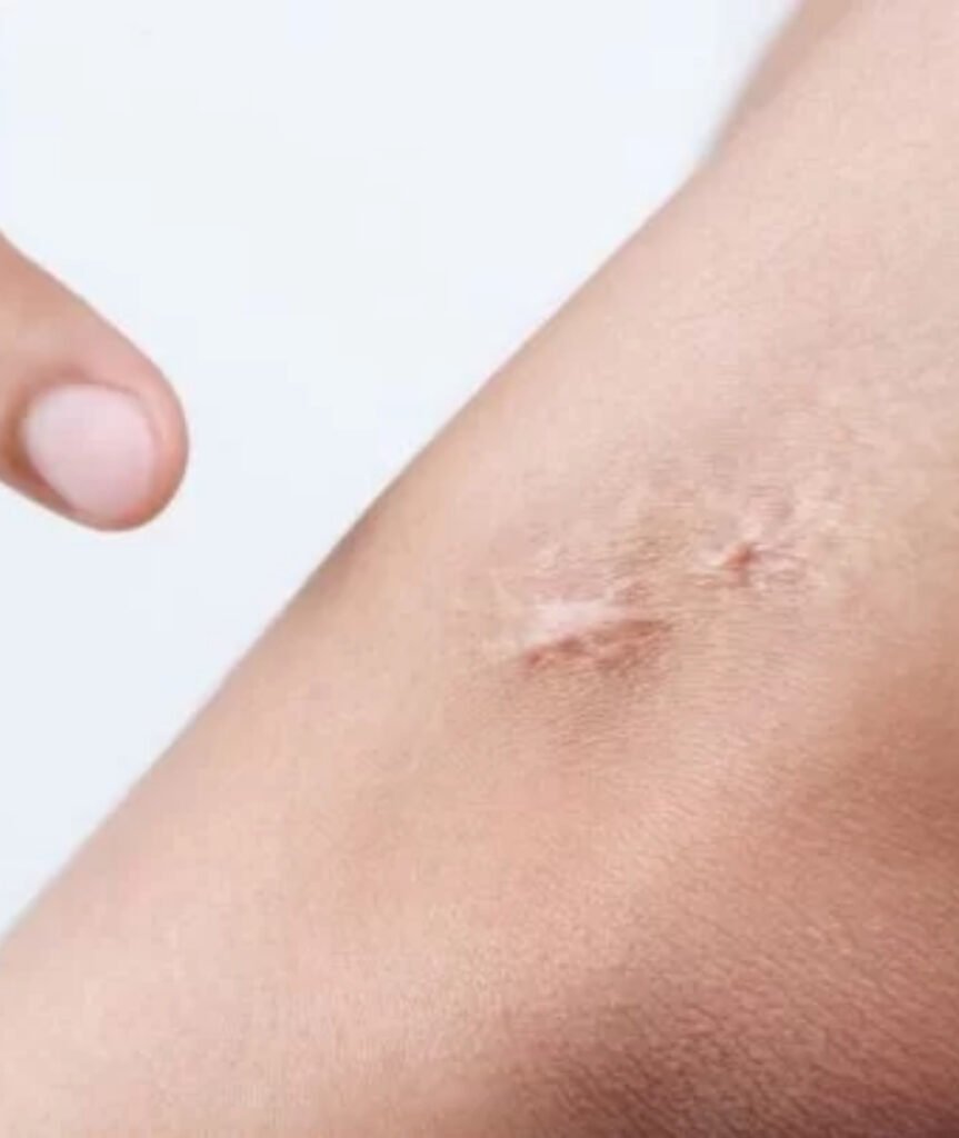 Scar Revision-Keloid Treatment in Ahmedabad