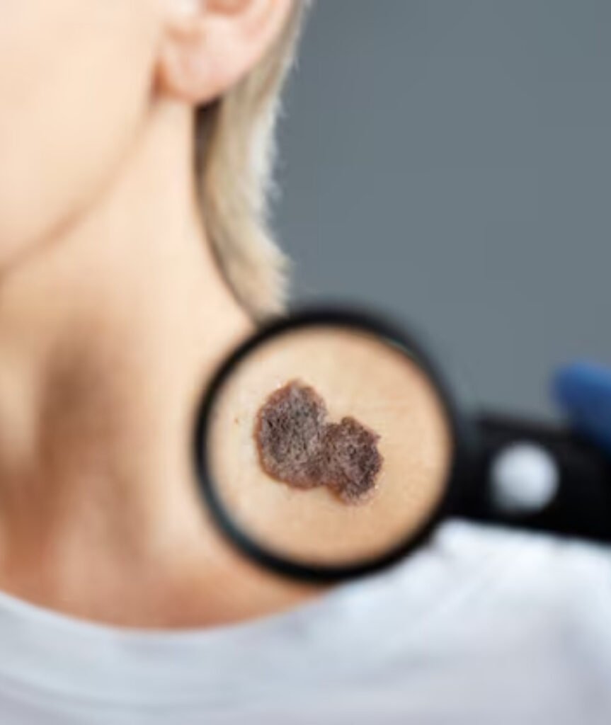 Skin Cancer Treatment