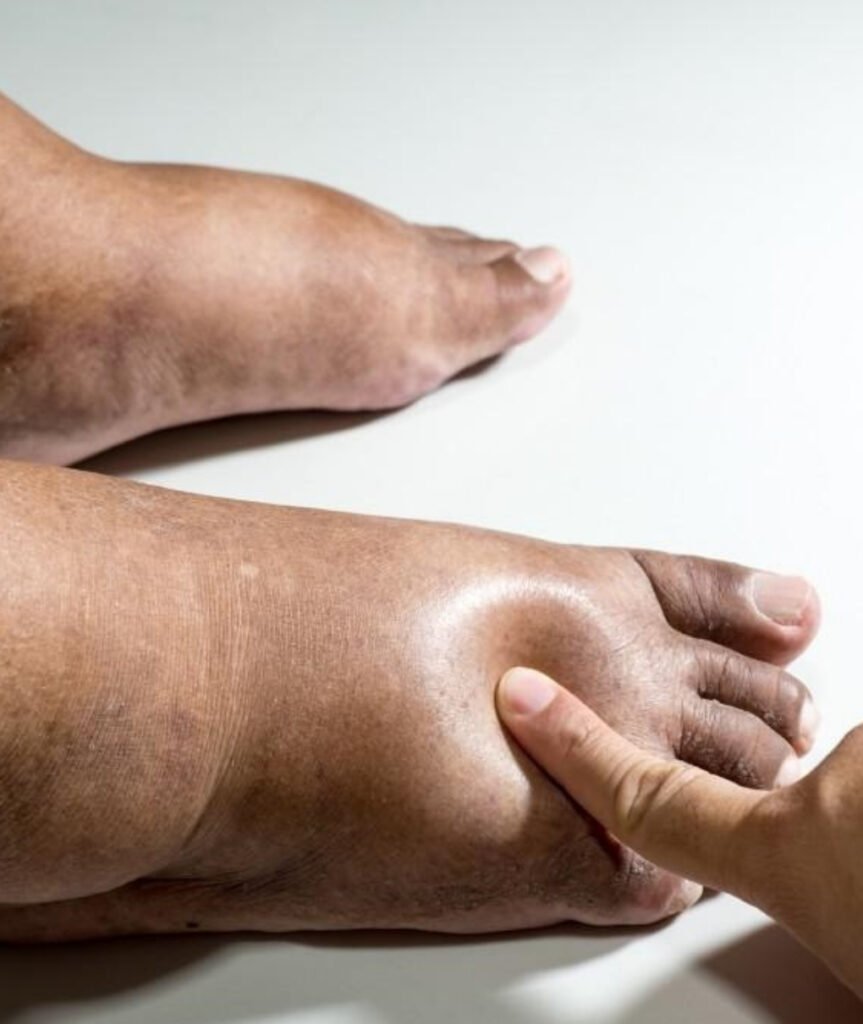 Diabetic Foot Surgery