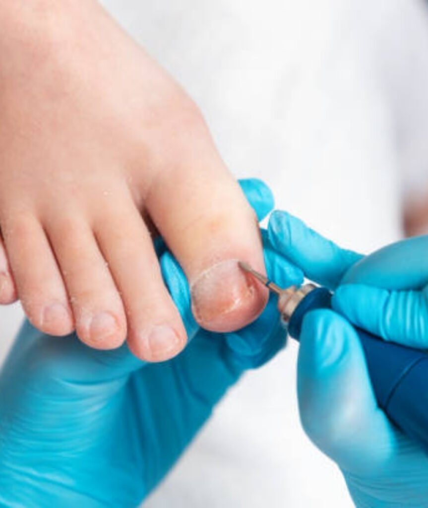 Ingrown Toenail Surgery​