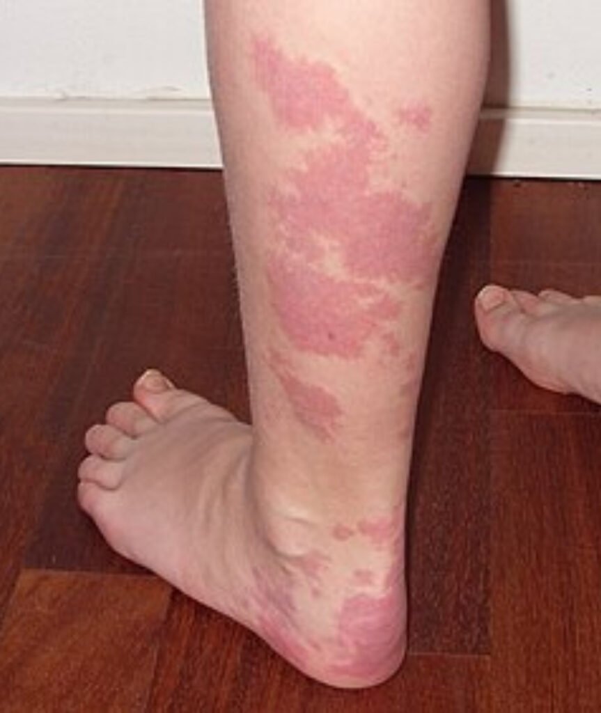 Vascular Malformation​