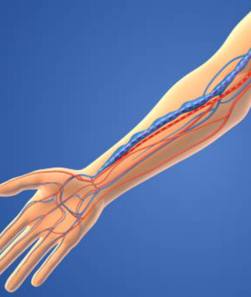 AV Fistula for Dialysis Surgery