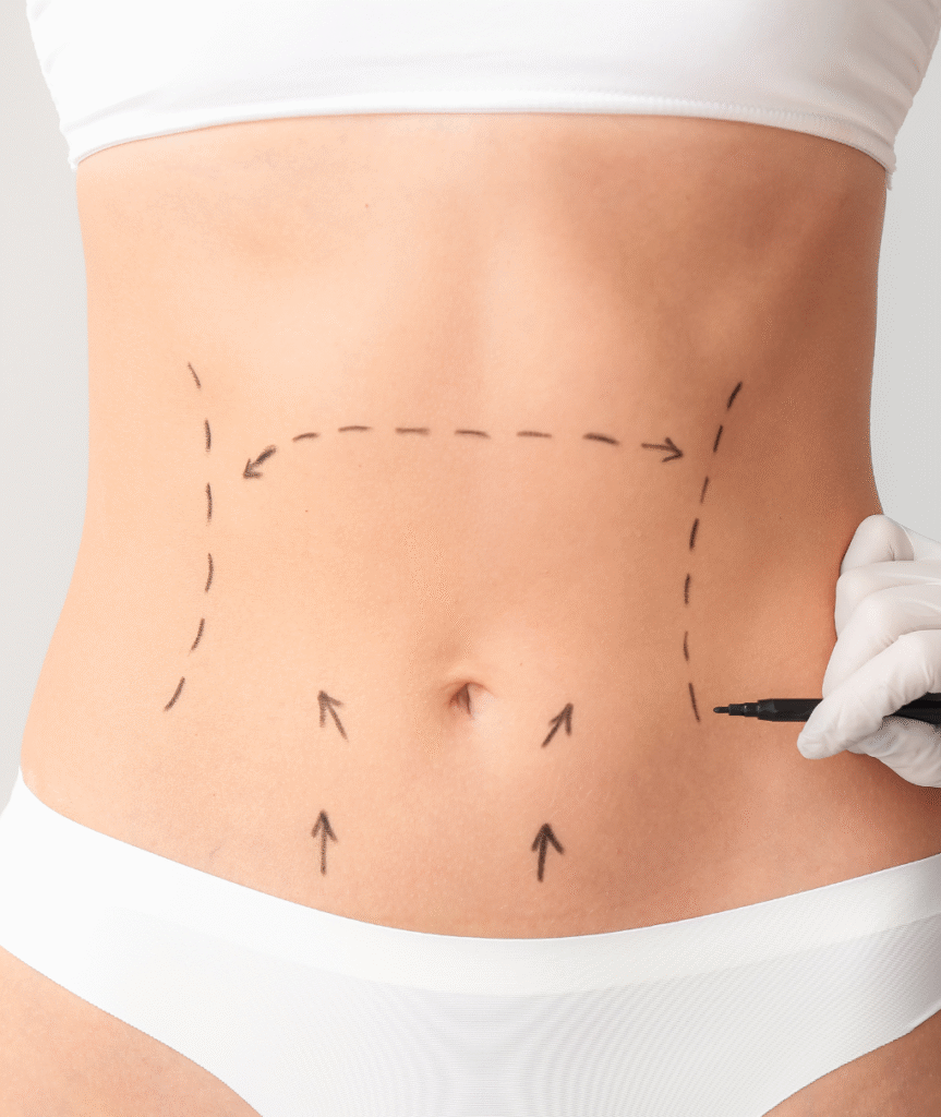 Tummy Tuck Surgery in Ahmedabad