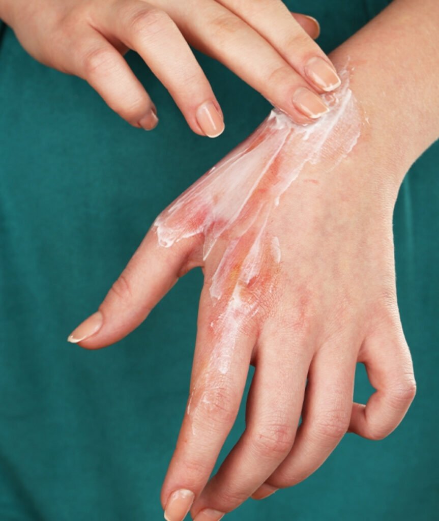 Post-Burn Contracture Release & Reconstruction in Ahmedabad