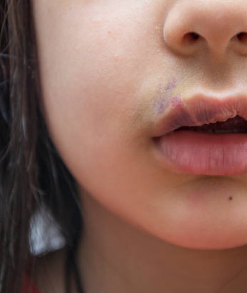 Cleft Lip & Palate Surgery