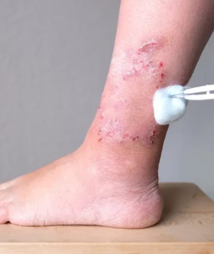 Diabetic Foot Surgery in Ahmedabad