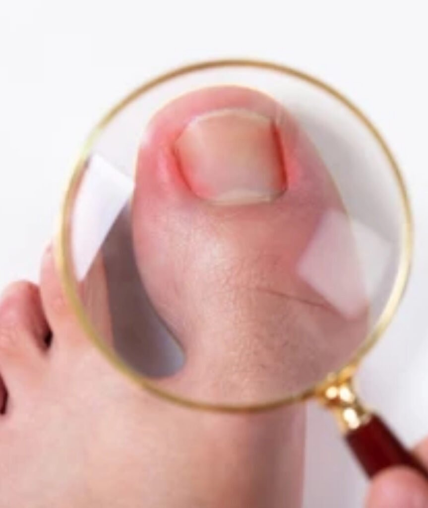 Ingrown Toenail Surgery​