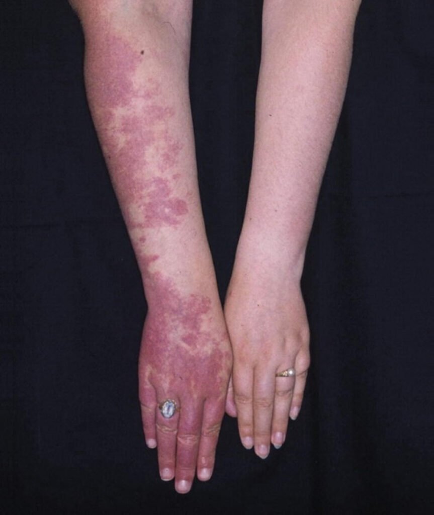 Vascular Malformation​