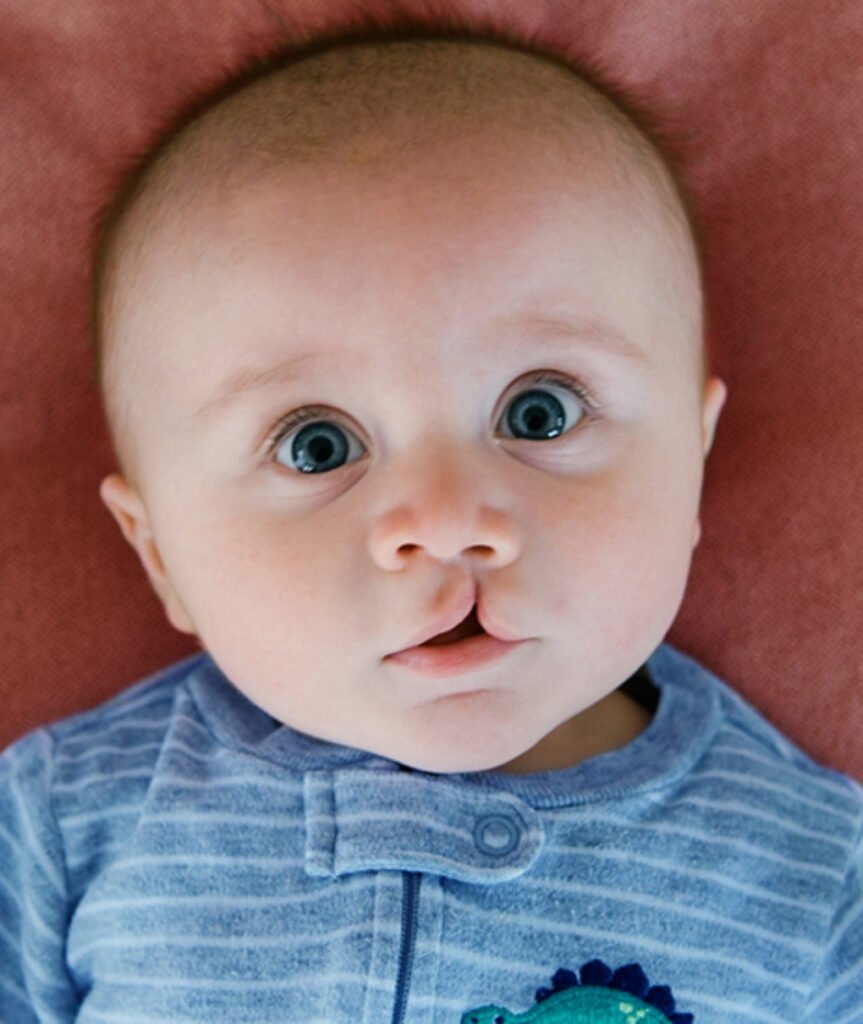 Cleft Lip & Palate Surgery