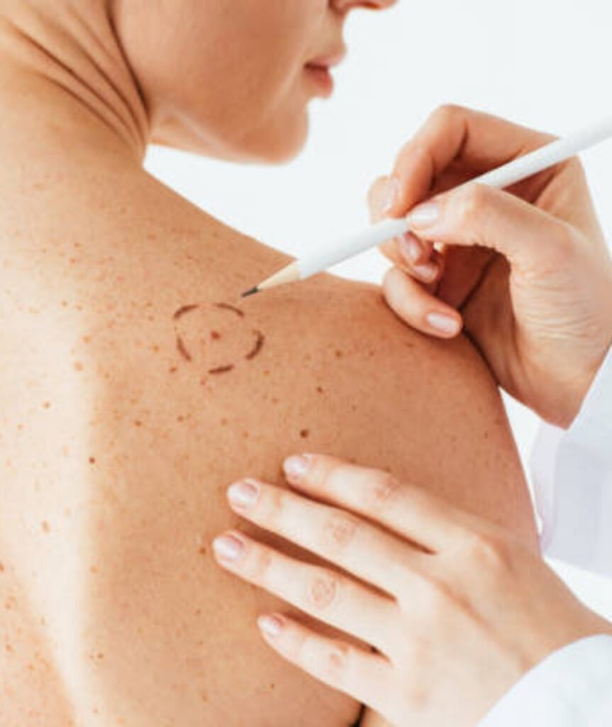 Skin Cancer Treatment