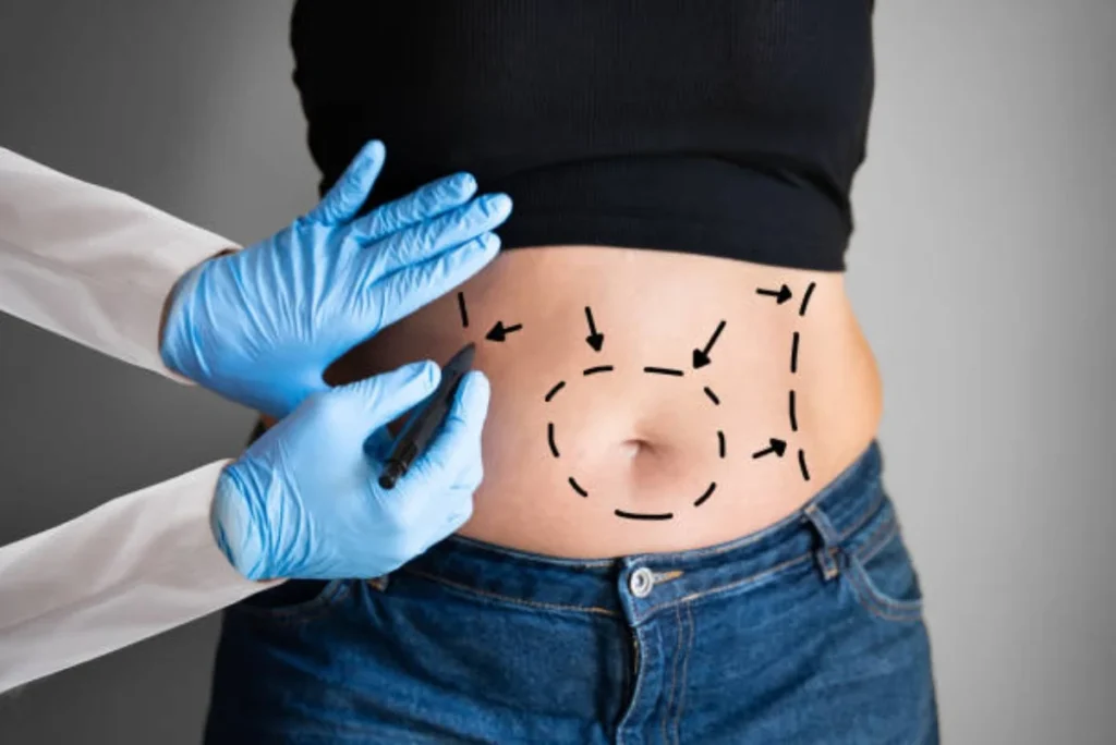 Tummy Tuck Surgery