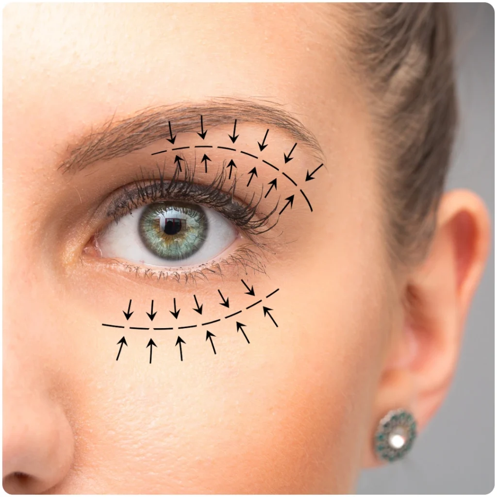Eyelid Surgery in Udaipur