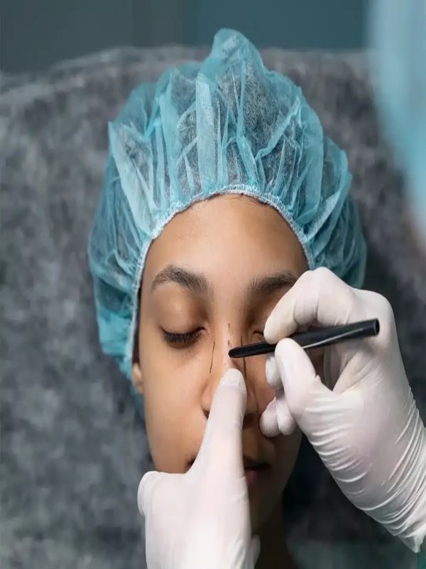Rhinoplasty in Indore