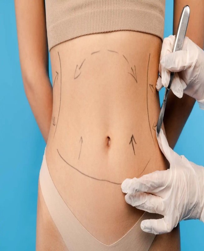 Liposuction Surgery